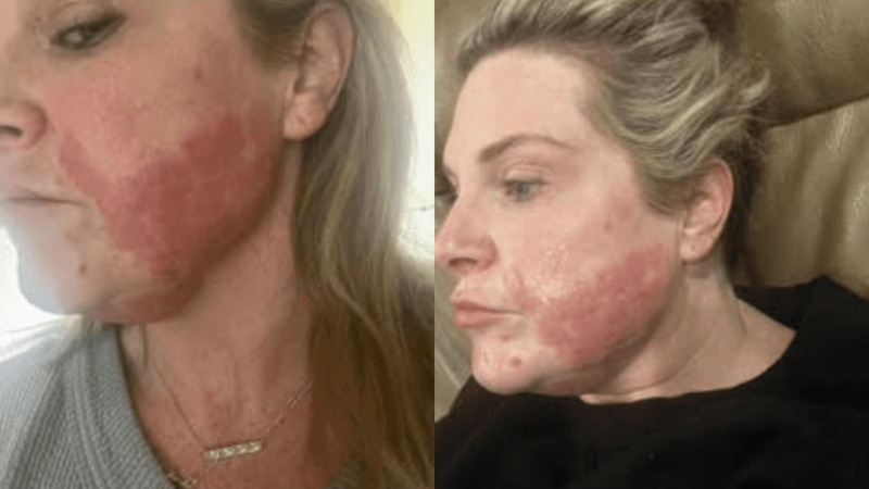My Microneedling Mishap and How Morpheus8 Saved My Skin